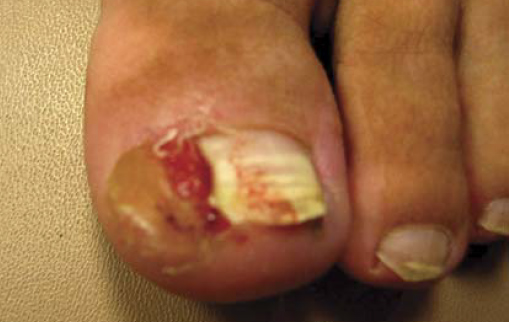 Пациент О., 43 лет, с диагнозом «вросший ноготь, пиогенная гранулема в области околоногтевого валика большого пальца левой стопы», до лечения
