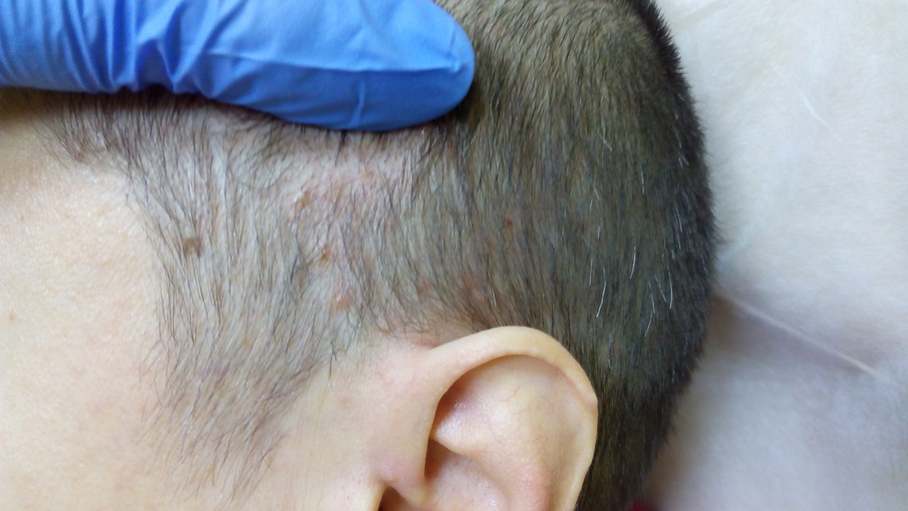 Себорейный дерматит лица, тела и волосистой части головы