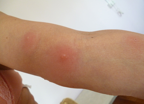 Как избавиться от укусов комаров? Отвечают врачи