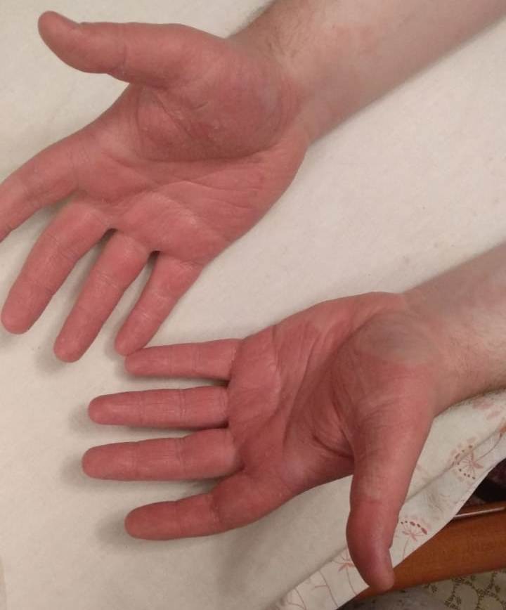 Как бороться со сухостью кожи рук: простые советы и эффективные методы - на сайте dermatology.ru