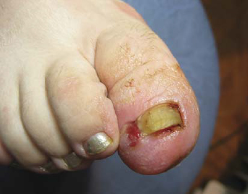 Пациентка У., 31 года, с диагнозом «вросший ноготь, пиогенная гранулема в области околоногтевого валика большого пальца правой стопы», до лечения. Гипергидроз стоп.