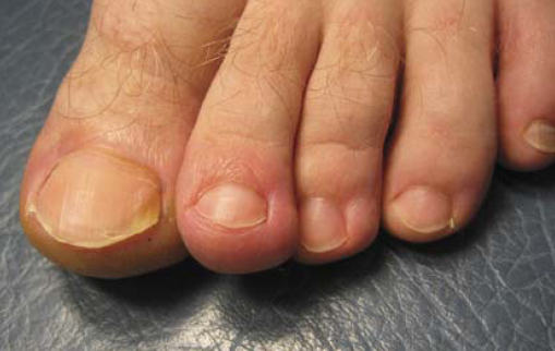 Пациент О., 43 лет, через 8 нед. Структура ногтевой пластинки восстановилась. Рецидива не отмечали.