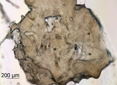Клещи рода Demodex в секрете сальной железы, полученные при соскобе